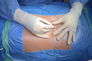 patient needing failed back surgery syndrome treatment in Orange