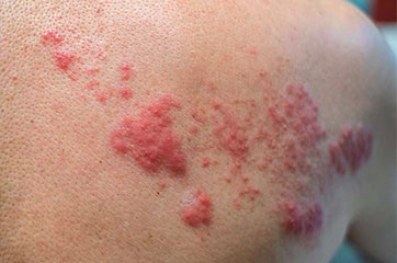 patient needing postherpetic neuralgia treatment in Orange