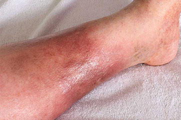 patient needing reflex sympathetic dystrophy treatment in Orange