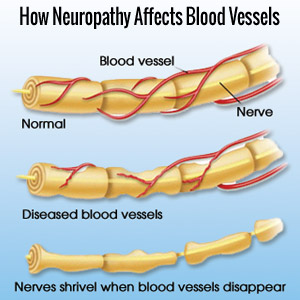 Peripheral Neuropathy